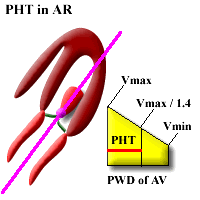 Aortic Valve Gradient