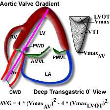 Aortic Valve Gradient