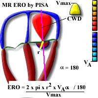 Aortic Valve Gradient