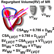 Aortic Valve Gradient