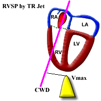 Aortic Valve Gradient